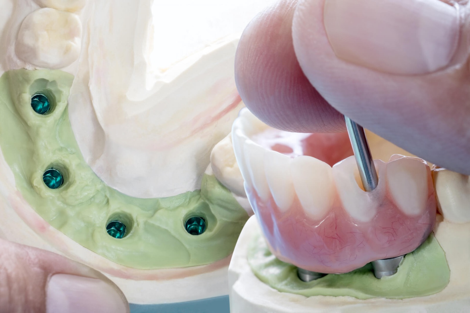 Implant Prosthesis